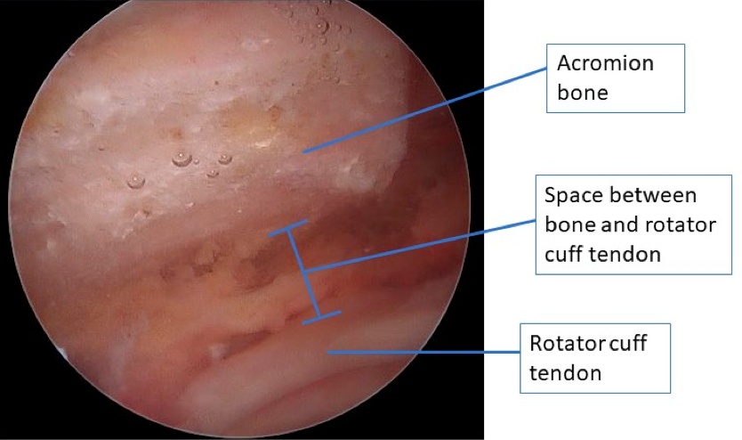 acromion labeled